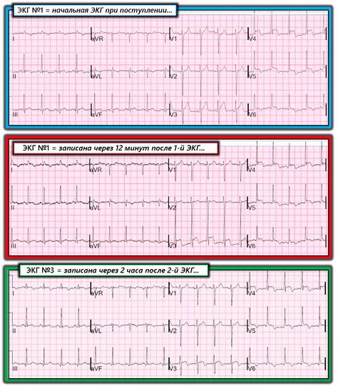 Показатели ЭКГ и их интерпретация
