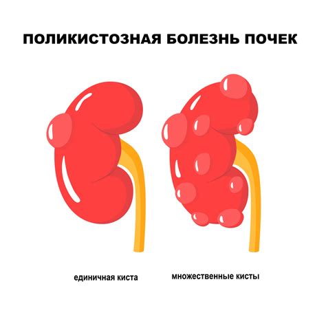 Поликистоз почек: основные симптомы