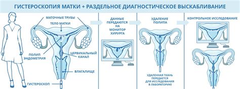 Полип эндометрия функционального типа: