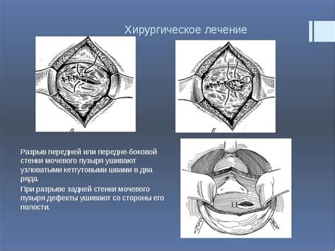 Полноценное описание пролапса передней стенки мочевого пузыря