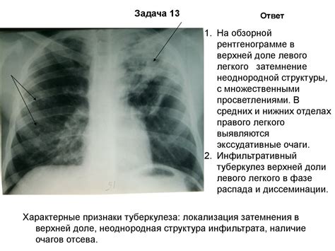 Положительная динамика КТ легких: значение и преимущества