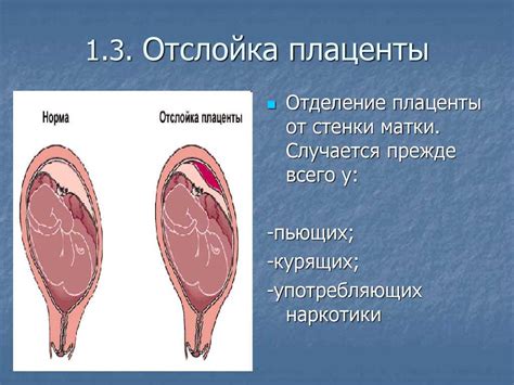 Получение понимания отслойки плаценты при родах