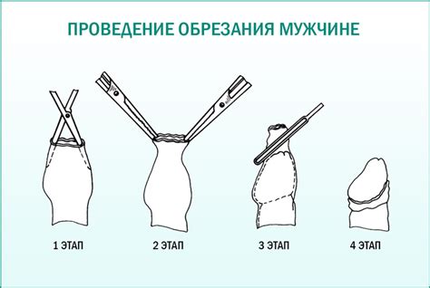 Польза и недостатки обрезания у мужчин