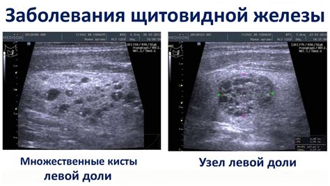 Польза качественного образования по УЗИ щитовидной железы