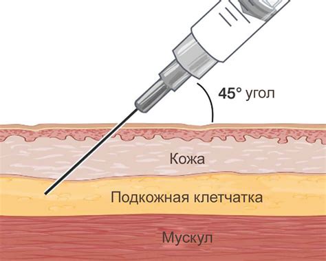 Польза подкожных инъекций