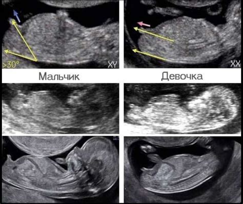 Пол ребенка по УЗИ и внутреннему чувству: как ориентироваться?