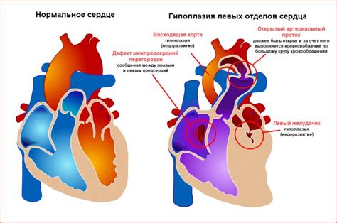 Понятие гипоплазии ЗСА