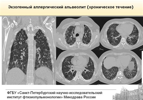 Понятие и значение легких диффузных изменений ирритативного характера