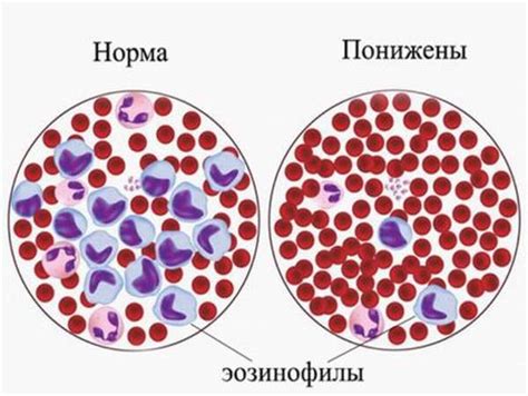 Понятие незрелых гранулоцитов