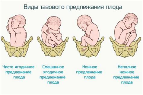 Понятие низкого положения головы у плода