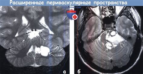 Понятие периваскулярных пространств и их функции