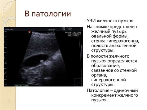 Понятие эхогенности печени