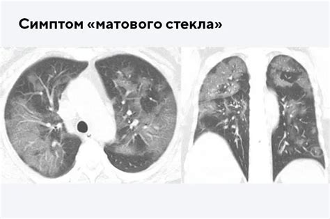 Поражение легких КТ3: первые признаки и наиболее распространенные симптомы