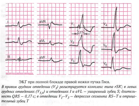 Последствия ЭКГ блокады