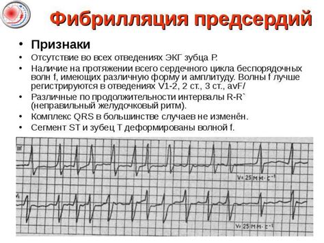 Последствия изменения предсердий на ЭКГ