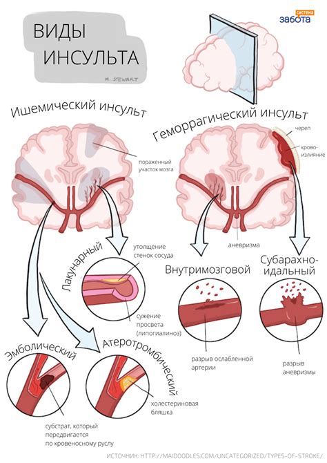 Последствия ишемического поражения головного мозга