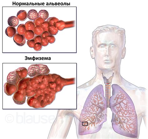 Последствия и осложнения аномального расширения легких