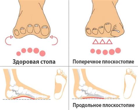 Последствия необратимого плоскостопия