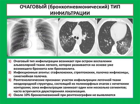 Последствия неравномерной пневматизации