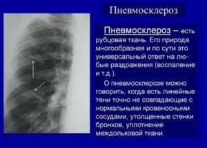 Последствия неравномерной пневматизации легочной паренхимы