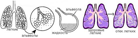 Последствия отека легкого