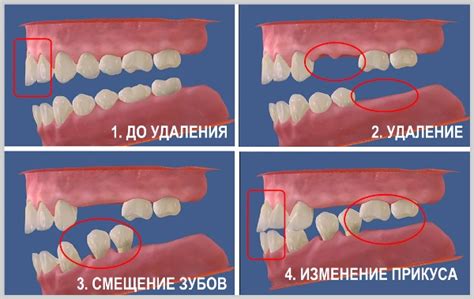 Последствия отсутствия лечения укороченного зубца pq