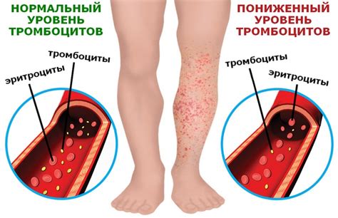 Последствия пониженного количества тромбоцитов