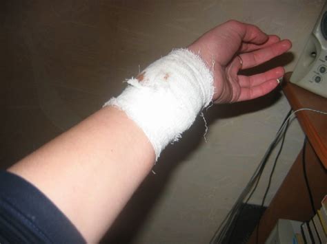 Последствия порезов левой руки: