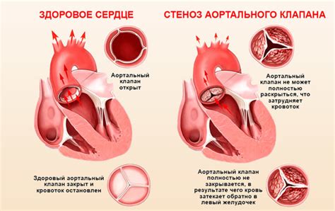 Последствия пропуска клапана сердца