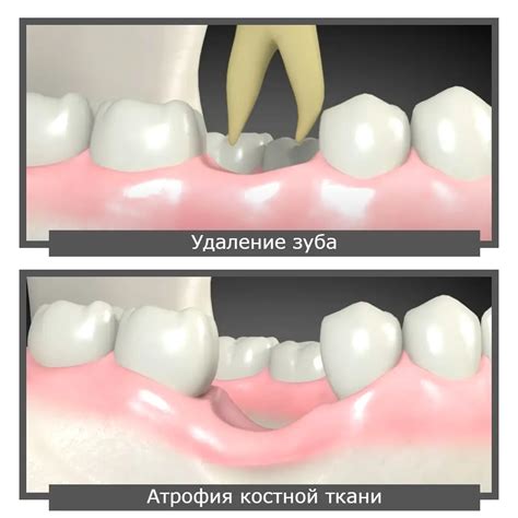 Последствия разрежения костной ткани зуба