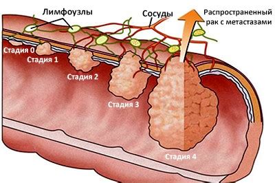 Последствия распада опухоли при раке кишечника