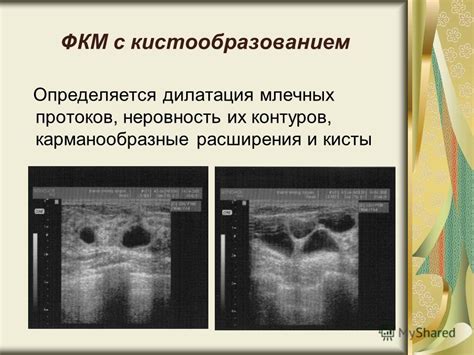 Последствия расширения млечных протоков