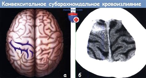 Последствия расширения субарахноидального конвекситального пространства у взрослых