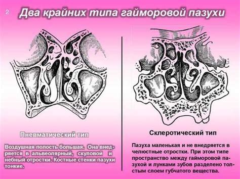 Последствия снижения пневматизации верхнечелюстных пазух