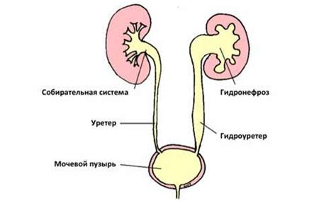 Последствия увеличения лоханки почки