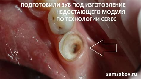 Последствия удаления корня зуба