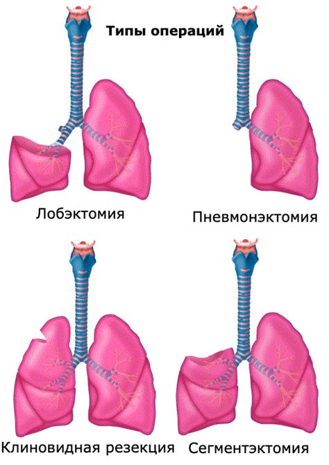 Последствия уменьшения легких