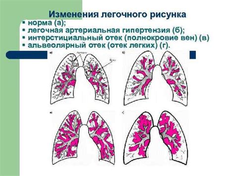 Последствия усиления деформации легочного рисунка