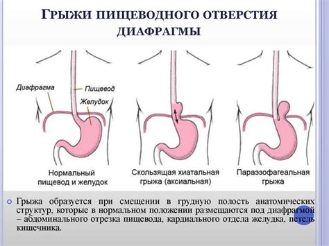 Последствия хиатуса пищеводного отверстия