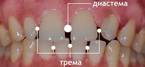 Последствия щелей между зубами