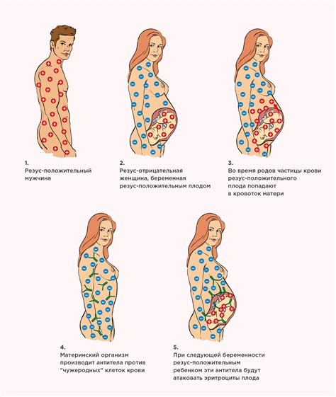 Потенциальные последствия конфликта резус-факторов для плода и матери