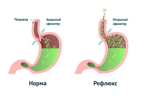 Почему возникает избыточное количество газов в желудке?