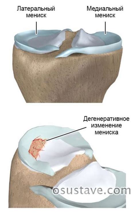 Почему возникает повреждение медиального мениска 3 степени по Stoller?