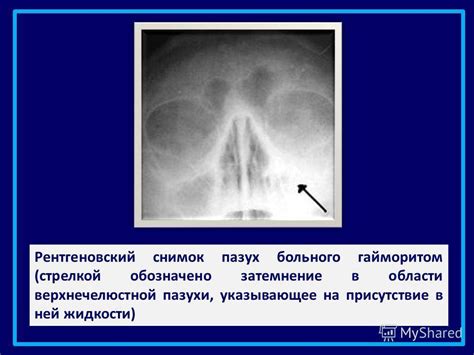 Почему возникает субтотальное затемнение верхнечелюстных пазух?