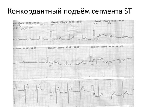 Почему конкордантный подъем сигнализирует о сердечной нагрузке?