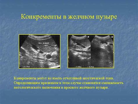 Почему конкременты не лоцируются?