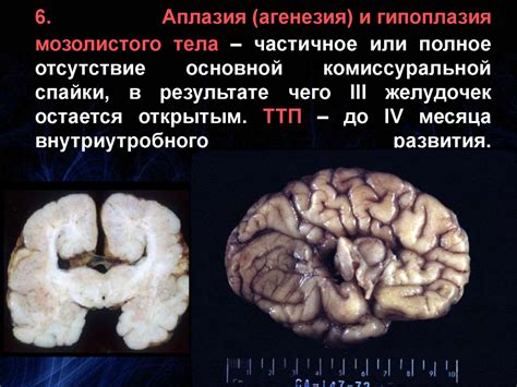 Почему нет мозолистого тела?