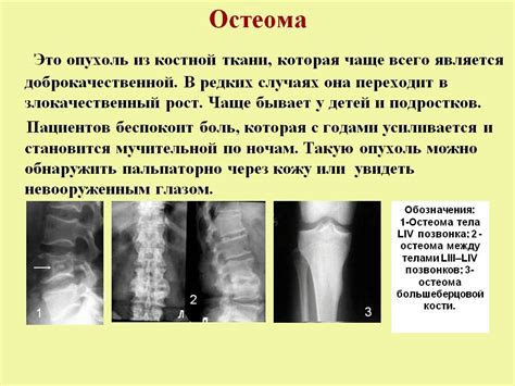 Почему остеосклероз не виден на рентгенограмме: причины и последствия