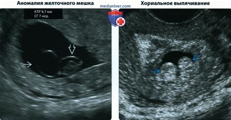 Почему плодное яйцо может быть несколько деформировано