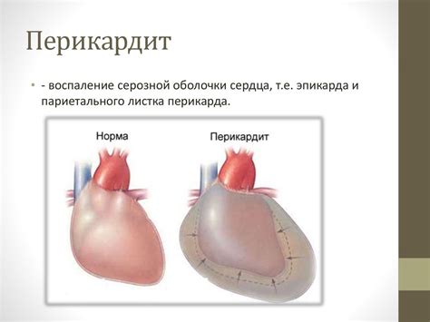 Почему снижена экскурсия наружного листка перикарда и как это влияет